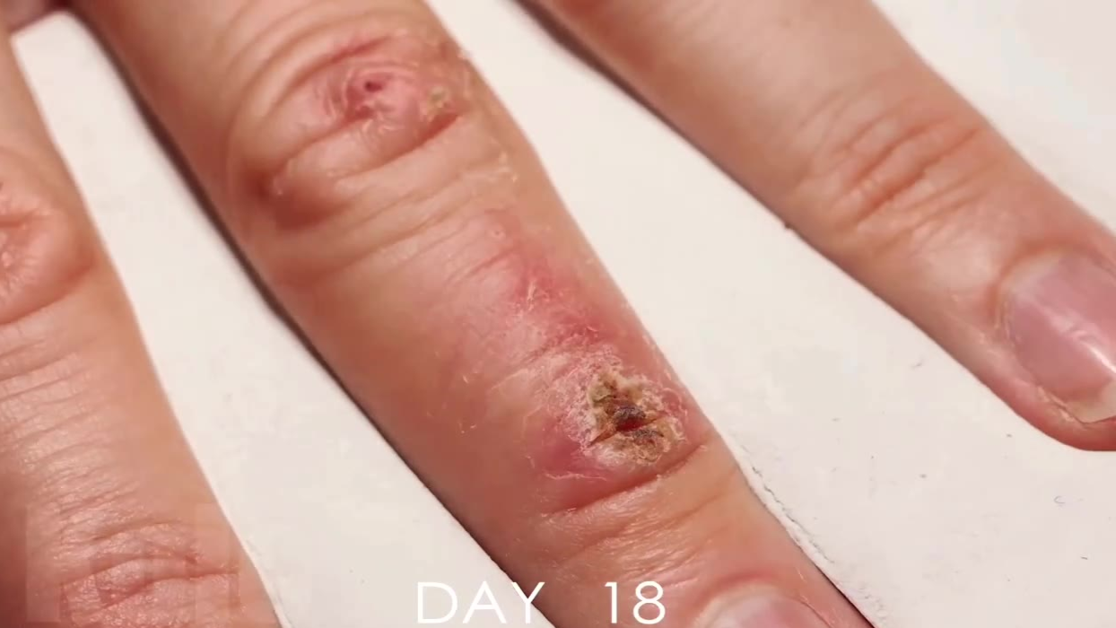 延时摄影——手指上的伤口在33天里的愈合过程